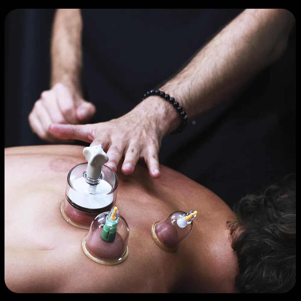 Cupping tecnica suzione
