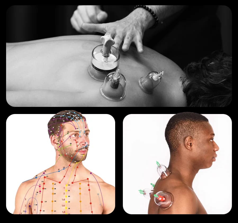 Coppettazione medicina cinese