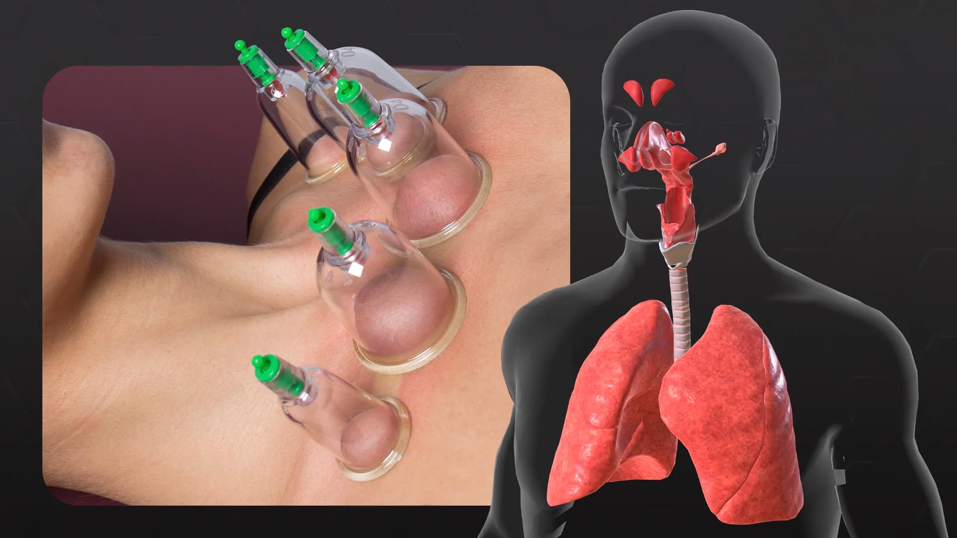 Coppettazione per prevenire e ridurre i sintomi della bronchite