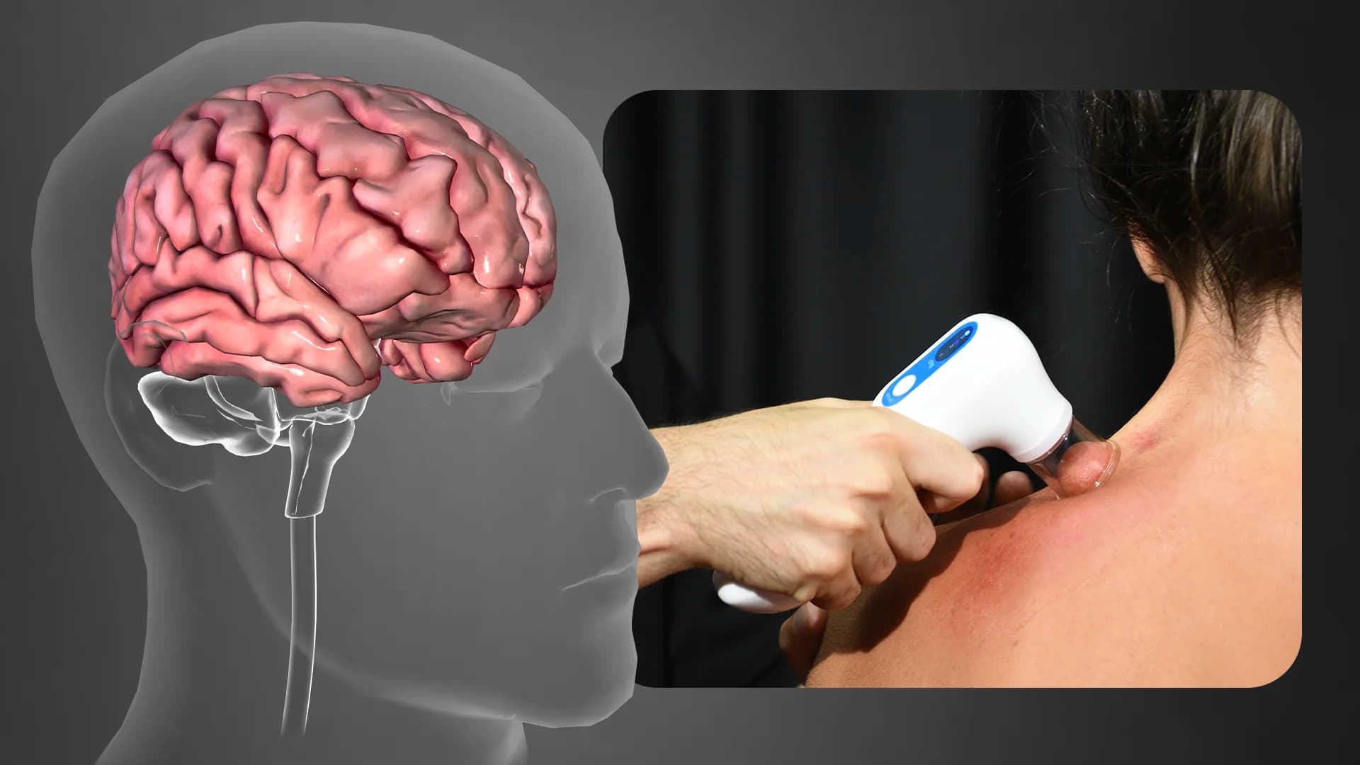 Coppettazione ed effetti benefici sulla depressione