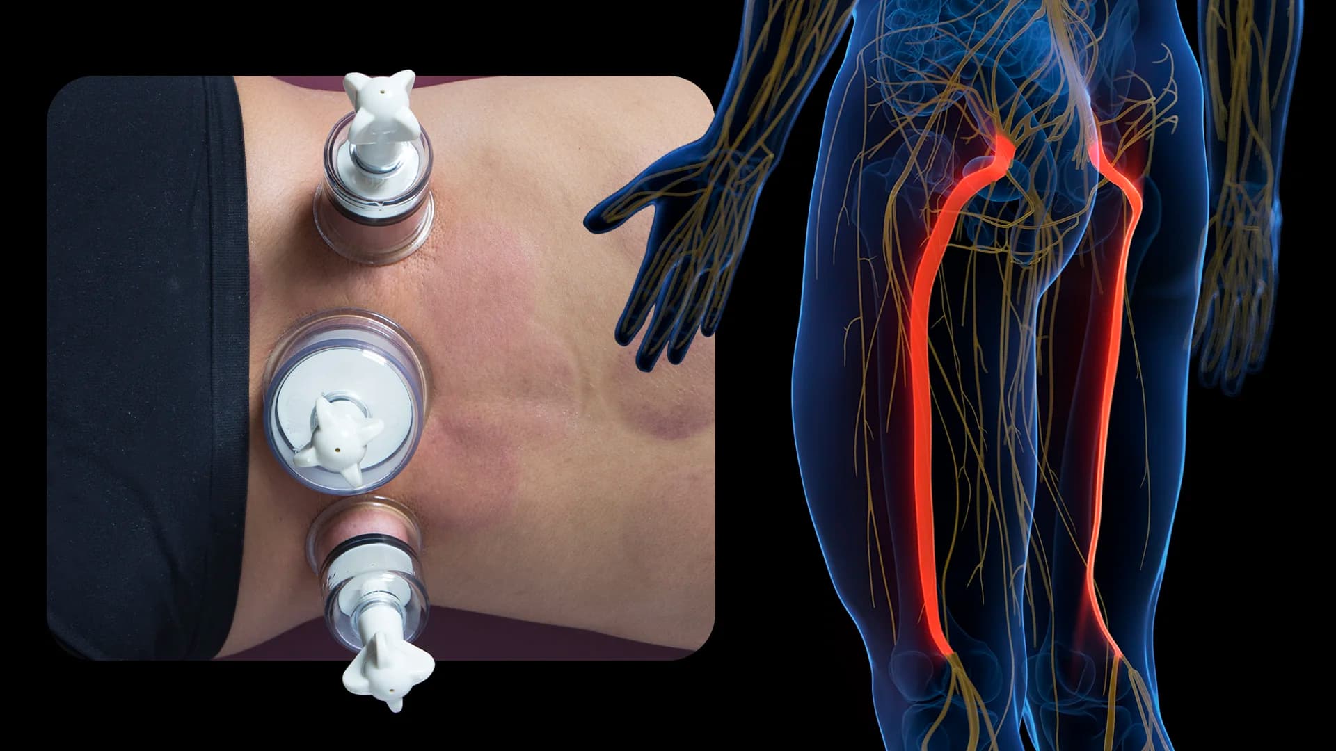 Sciatalgia e Coppettazione, trattamento e indicazioni