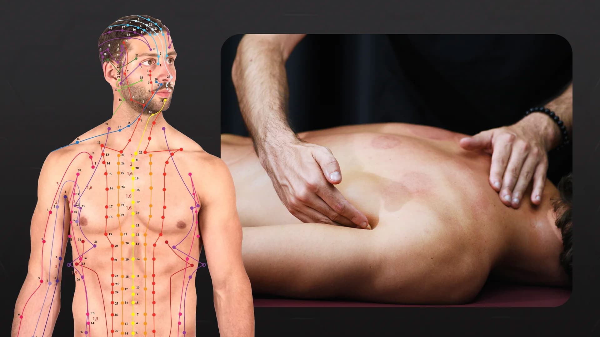 Agopunti per la Coppettazione